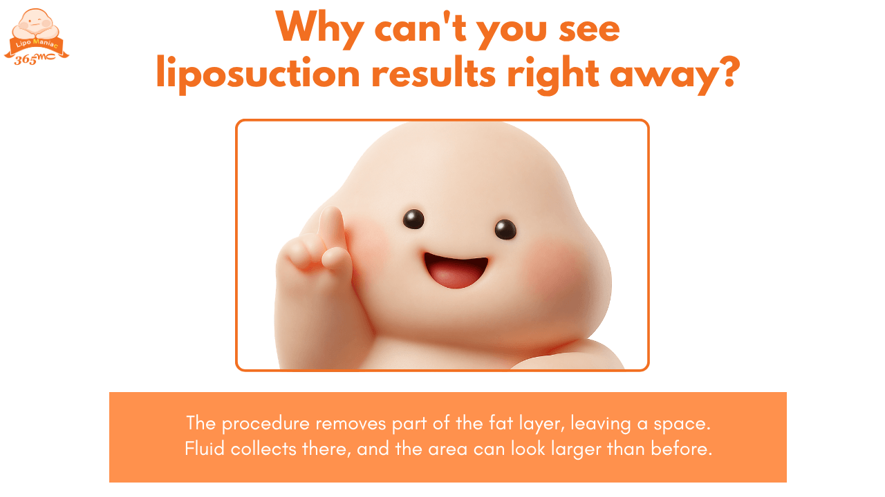 Illustration explaining why liposuction results may not appear immediately after treatment