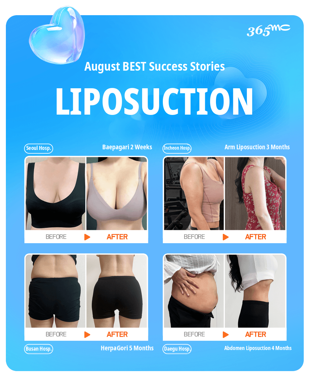 Four before and after liposuction results from 365mc hospitals in August