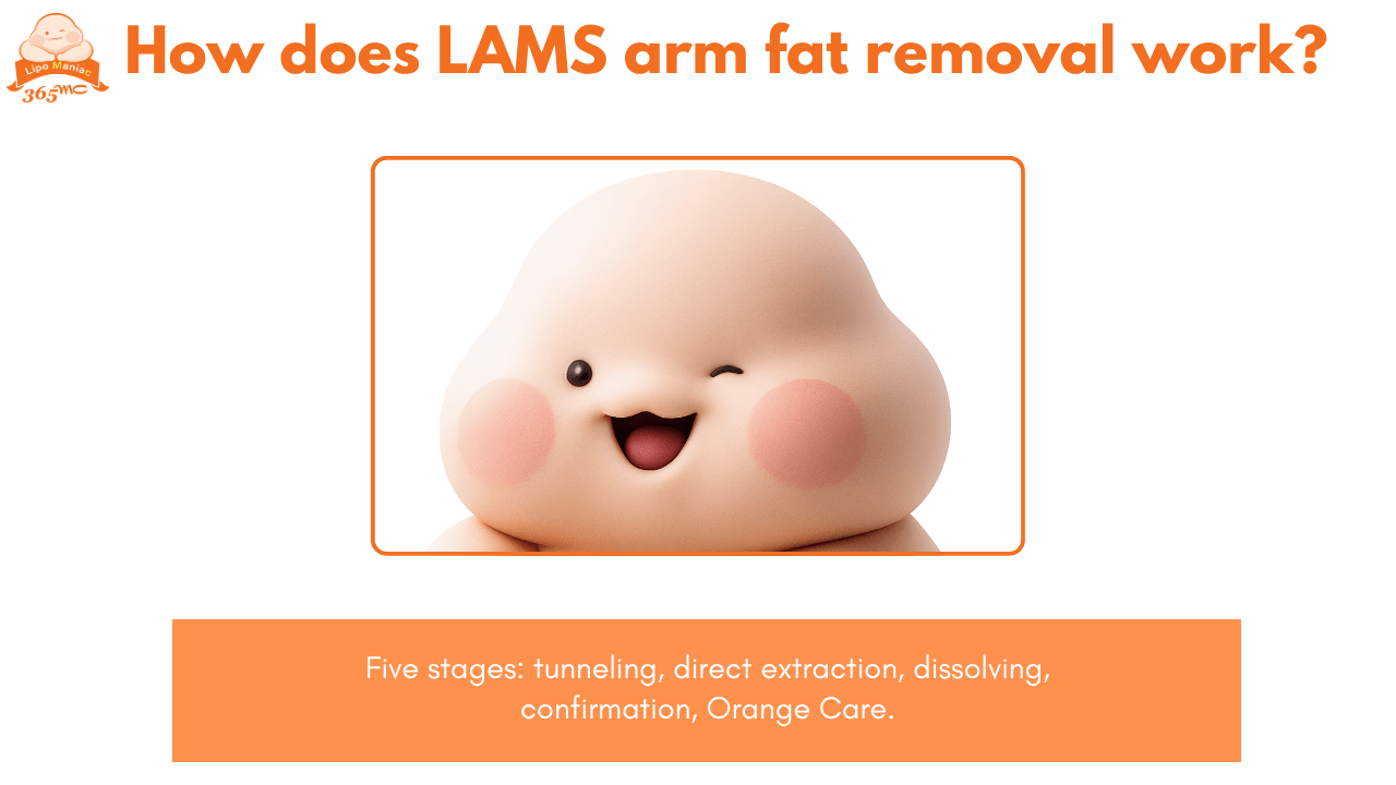 Illustration showing how LAMS arm fat removal works