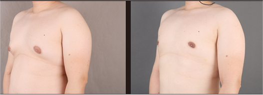 Gynecomastia liposuction before and after result at 365mc
