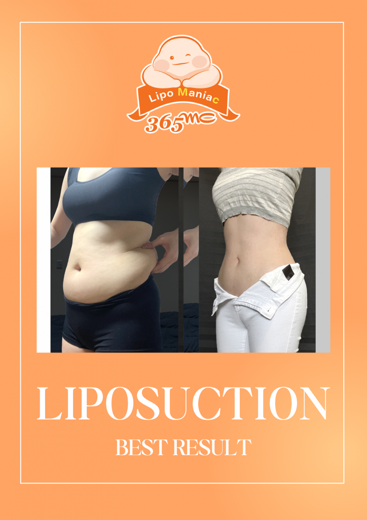 IMAGE 4 LIPO BEST RESULT