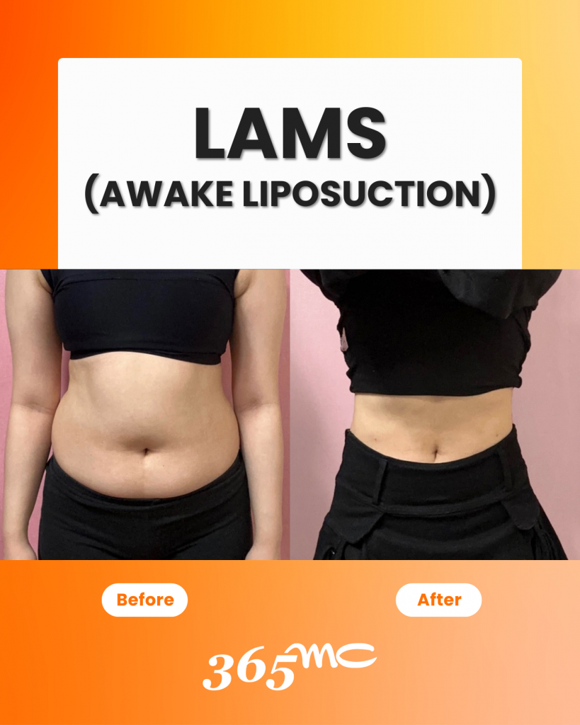 LAMS procedure educational information and patient care details