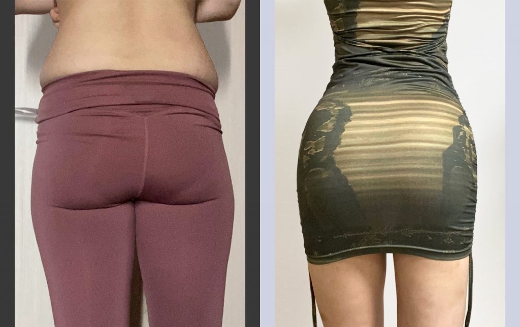 Mommy Makeover: Liposuction After Pregnancy