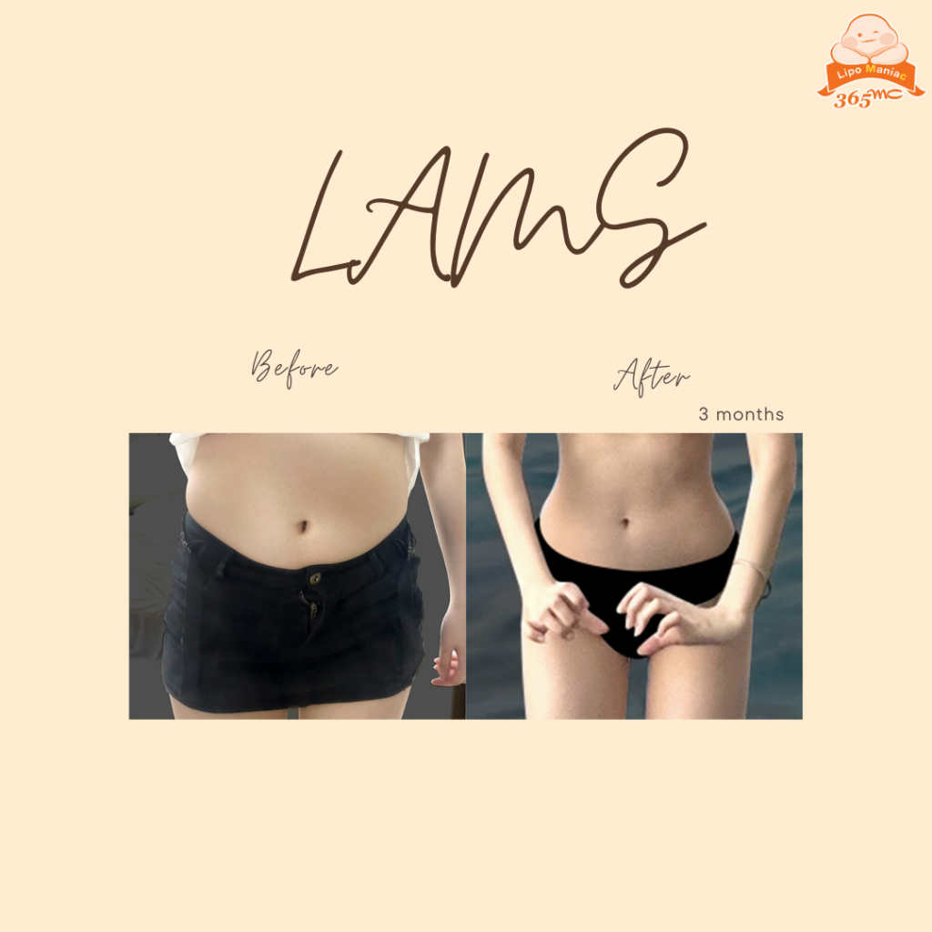 LAMS procedure educational information and patient care details