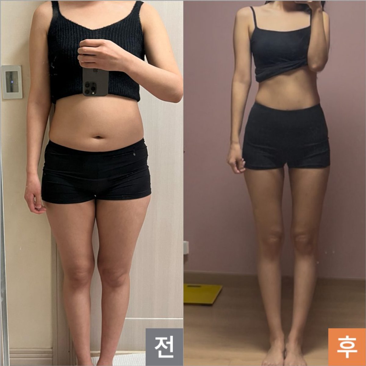 LAMS leg liposuction before and after transformation