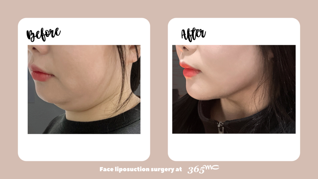 20240425-Image-2-Face Liposuction_ 2 months after