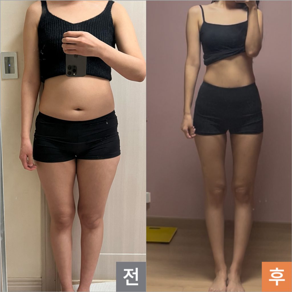 LAMS leg liposuction before and after transformation