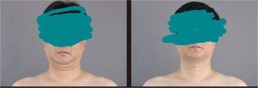 Chin liposuction before and after for men at 365mc