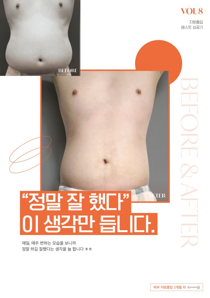 Male abdomen liposuction before and after result at 365mc